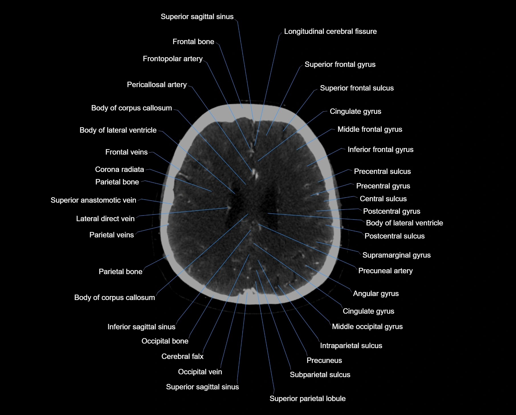 CT scan brain axial labelled cross sectional anatomy image-img-000048.webp
